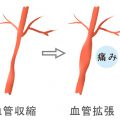 片頭痛の薬（痛みを止める薬）