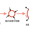 片頭痛のしくみ
